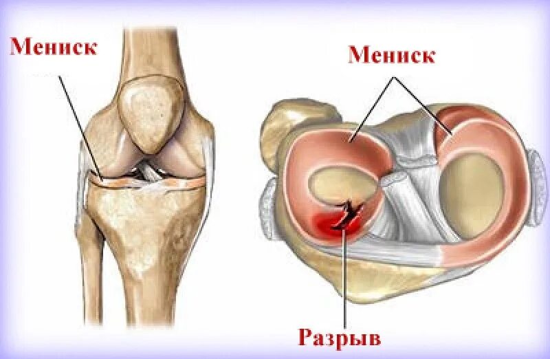 Разрыв медиального мениска коленного сустава. Медиальный мениск разрыв медиального. Корень мениска анатомия. Мениски коленного сустава анатомия разрыв.
