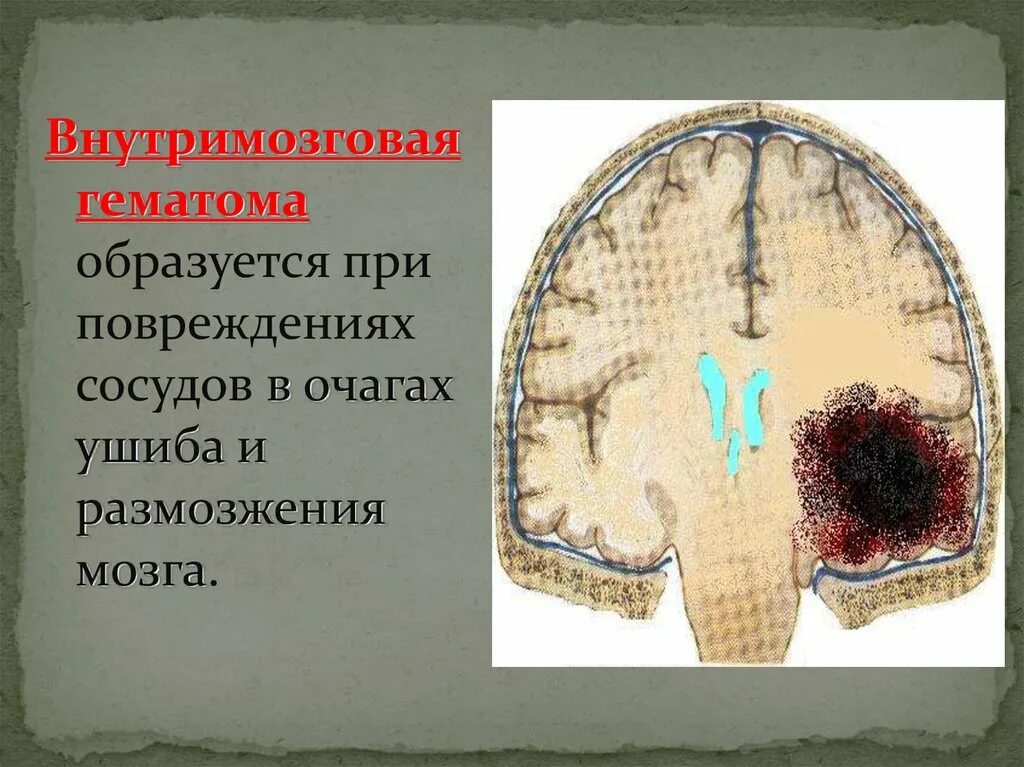 Субфасциальная гематома. Внутримозговая гематома. Гематома в головном мозге. Субдуральная и эпидуральная гематома. Субдуральная гематома лечение