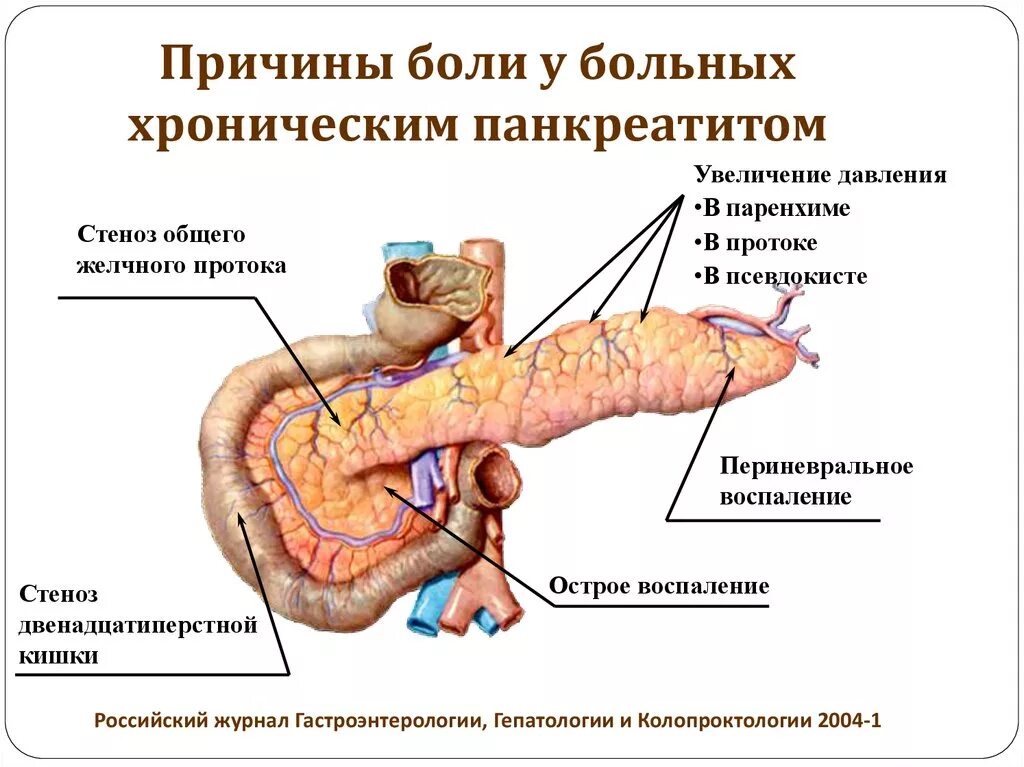 Покажи картинку поджелудочной железы. Хронический панкреатит. Положение больного при хроническом панкреатите. Панкреатический проток поджелудочной железы. Что такое панкреатит поджелудочной.