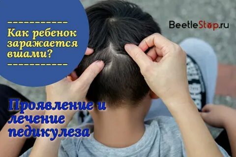 Как заражаются педикулезом