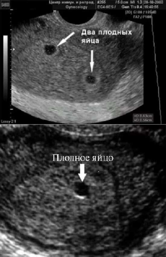 5 акушерская неделя. Эмбрион на 5 неделе беременности УЗИ. УЗИ плодного яйца на 5 неделе беременности. Два плодных яйца на УЗИ 5 недель беременности. УЗИ беременности плодное яйцо 4 недели.