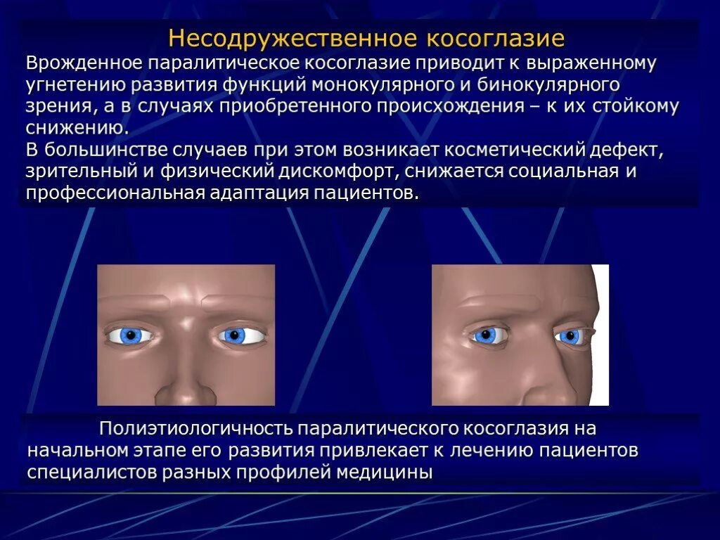 Косоглазие симптомы. Патогенез паралитического косоглазия. Содружественное и паралитическое косоглазие. Паралитическое косоглазие этиология. Врожденное косоглазие.