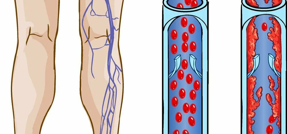 Венозный застой крови. Варикозное расширение вен тромбофлебит и флеботромбоз. Септический тромбофлебит. Илеофеморальный тромбоз глубоких вен. Илеофеморальный венозный тромбоз.