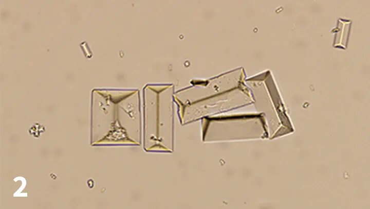Растворение струвитов. Струвиты микроскопия. Струвиты и оксалаты. Струвиты в моче. Струвиты у собаки.