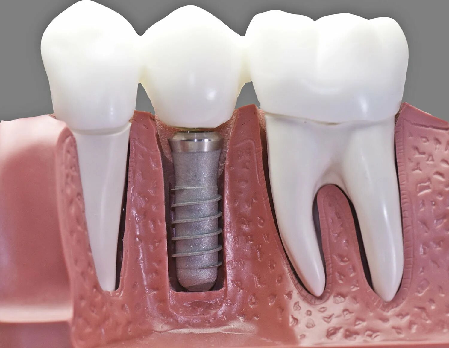 Имплант dentium superline. Импланты схема установки имплантация. Имплант зубной альфа био. Имплант формирователь коронка. Ортопедические импланты.