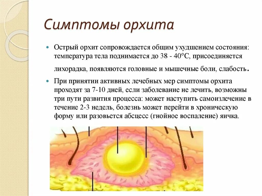 Орхит симптомы. Орхит (воспаление яичка). орхит это воспаление семенников.