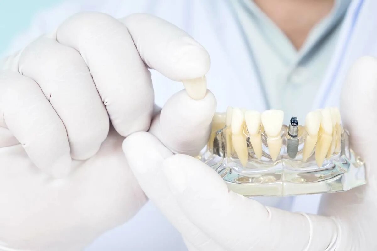 Протезирование зубов инвалиду 1 группы. Имплантация зубов Сток. Dental prosthesis.