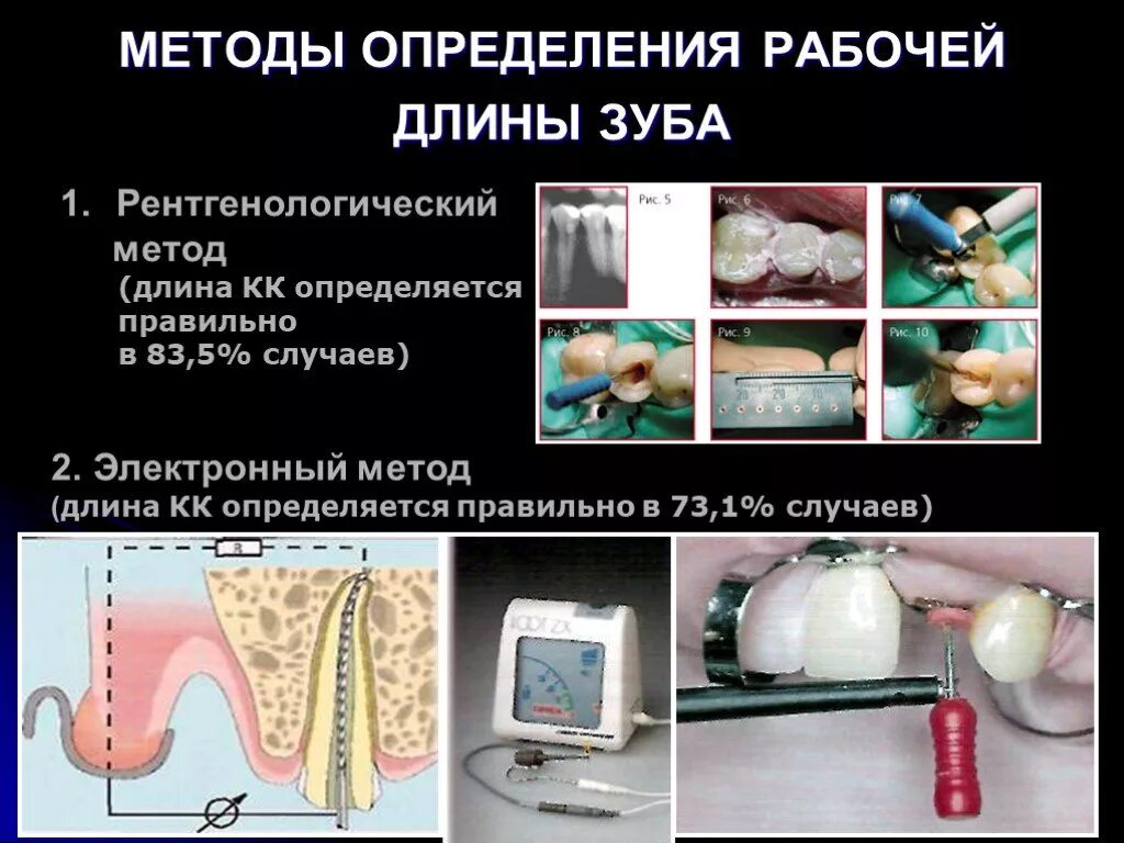 Определение корневых каналов. Методы измерения рабочей длины корневого канала. Тактильный метод определения рабочей длины корневого канала. Метод определения рабочей длины корневого канала. Метод определения рабочей длины каналов зуба.