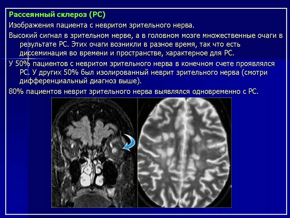 Склероз мозга. Очаги склероза. Рассеянный склероз патология. Рассеянный склероз зрительного нерва. Очаги рассеянного склероза в головном мозге.