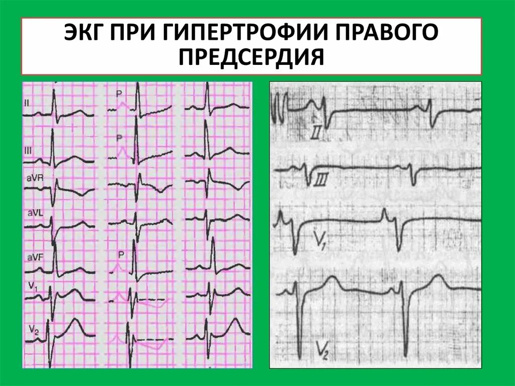 ЭКГ при гипертрофии правого предсердия. Гипертрофия левого желудочка на ЭКГ. Гипертрофия правого желудочка на ЭКГ. ЭКГ при гипертрофиях миокарда желудочков и предсердий.. Гипертрофия левого предсердия левого желудочка