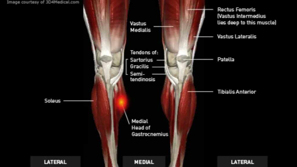 Икроножная мышца прикрепляется к. Gastrocnemius мышца. Икроножная мышца голени. Икроножная мышца латынь. Почему болят мышцы икры