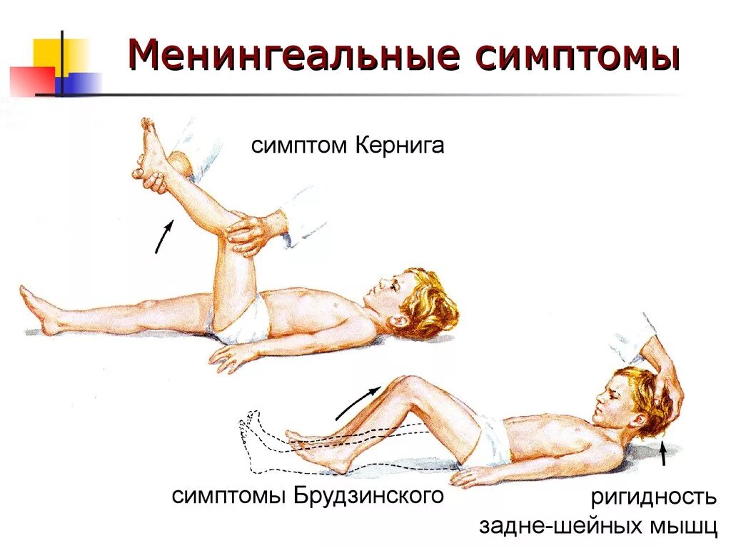 Ригидность затылка. Менингеальные симптомы Кернига. Симптом Кернига и Брудзинского при менингите. Симптомы Кернига Брудзинского ригидность мышц. Положительные симптомы Кернига и Брудзинского.