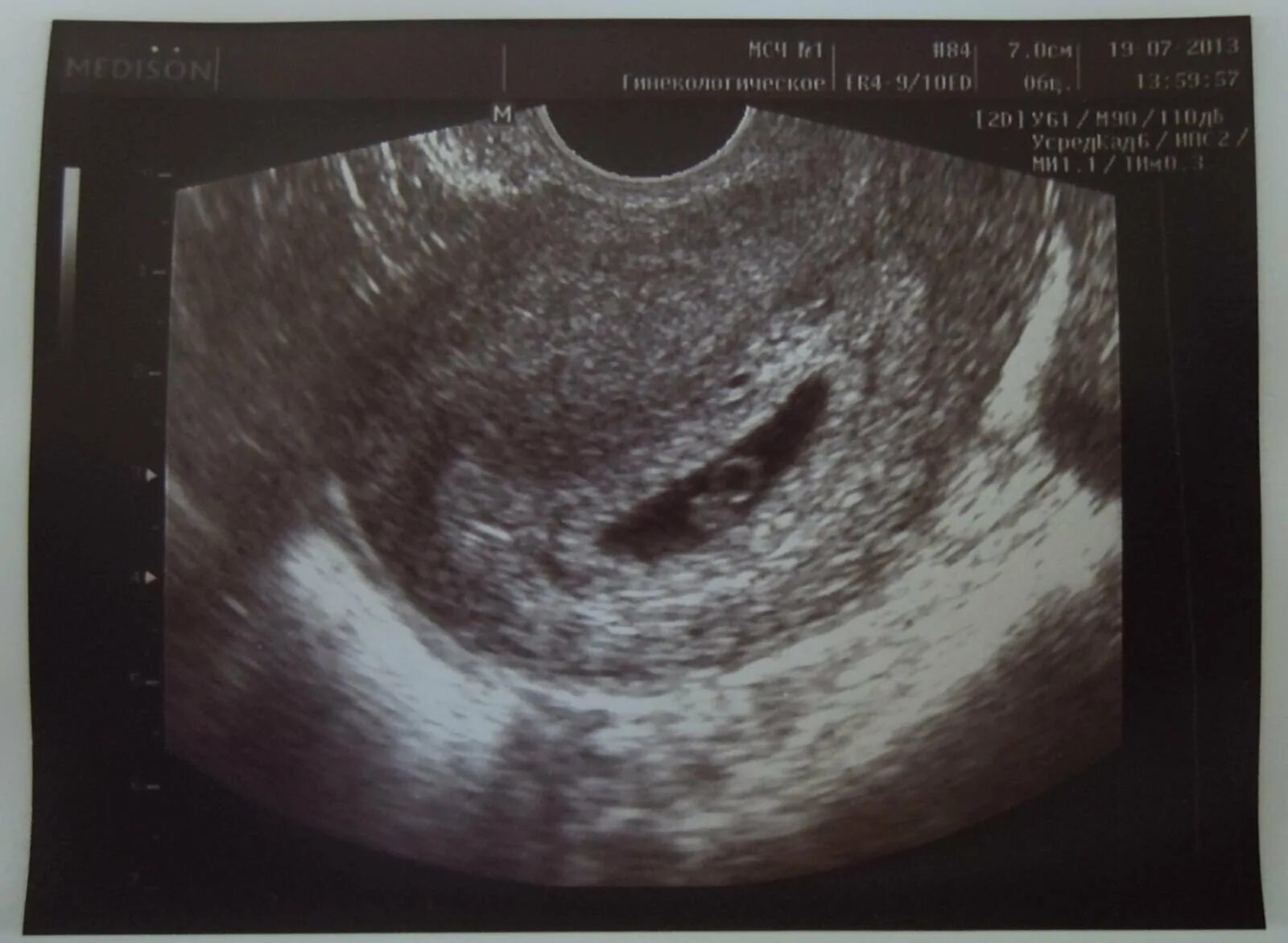 Снимок УЗИ при беременности 6 недель. УЗИ 6 недель беременности гипертонус. УЗИ беременность 5 недель гипертонус матки.