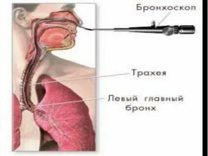 Рак трахеи
