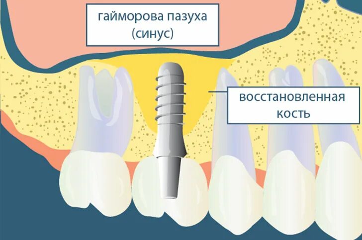 Синус-лифтинг (костная пластика, остеопластика). Латеральный синус-лифтинг. Операция закрытый синус-лифтинг. Открытый синус-лифтинг наращивание костной ткани. Синус лифтинг в спб