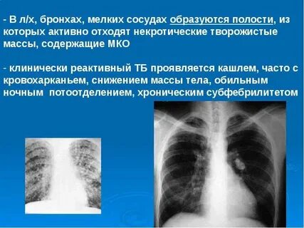Микобактериоз легких
