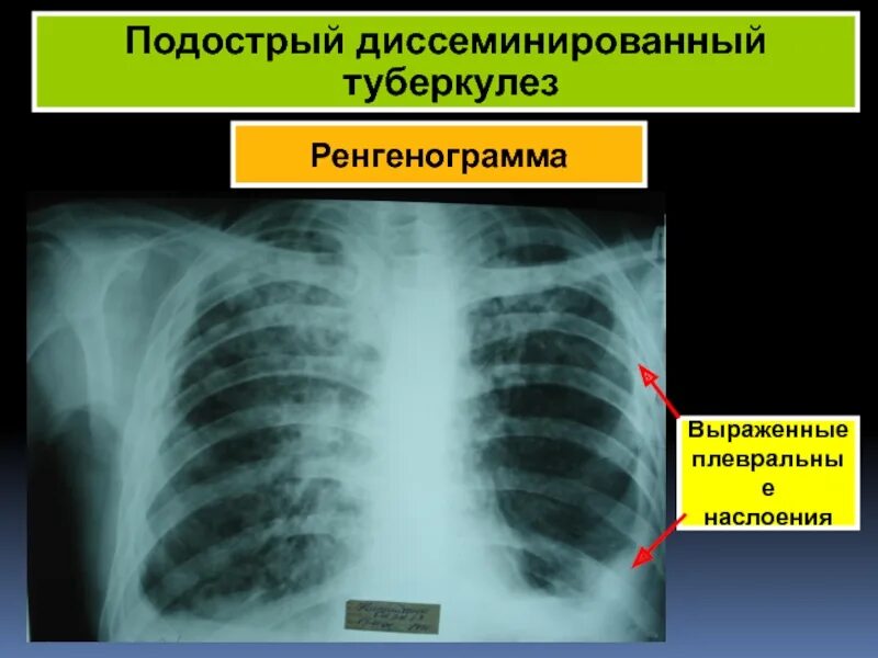 Острый диссеминированный туберкулез. Острый диссеминированный туберкулез рентген. Подострый диссеминированный туберкулез рентген. Плевральные наслоения. Хронический диссеминированный туберкулез.