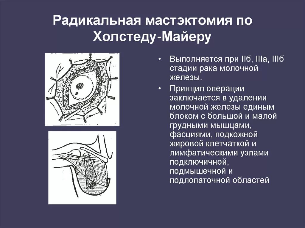 После операции опухоли молочной железы. Радикальная мастэктомия по Мадден. Радикальная мастэктомия по Холстеду Майеру. Операция - радикальная мастэктомия (по Холстеду-Майеру). Радикальная мастэктомия по пейти-Дайсону.