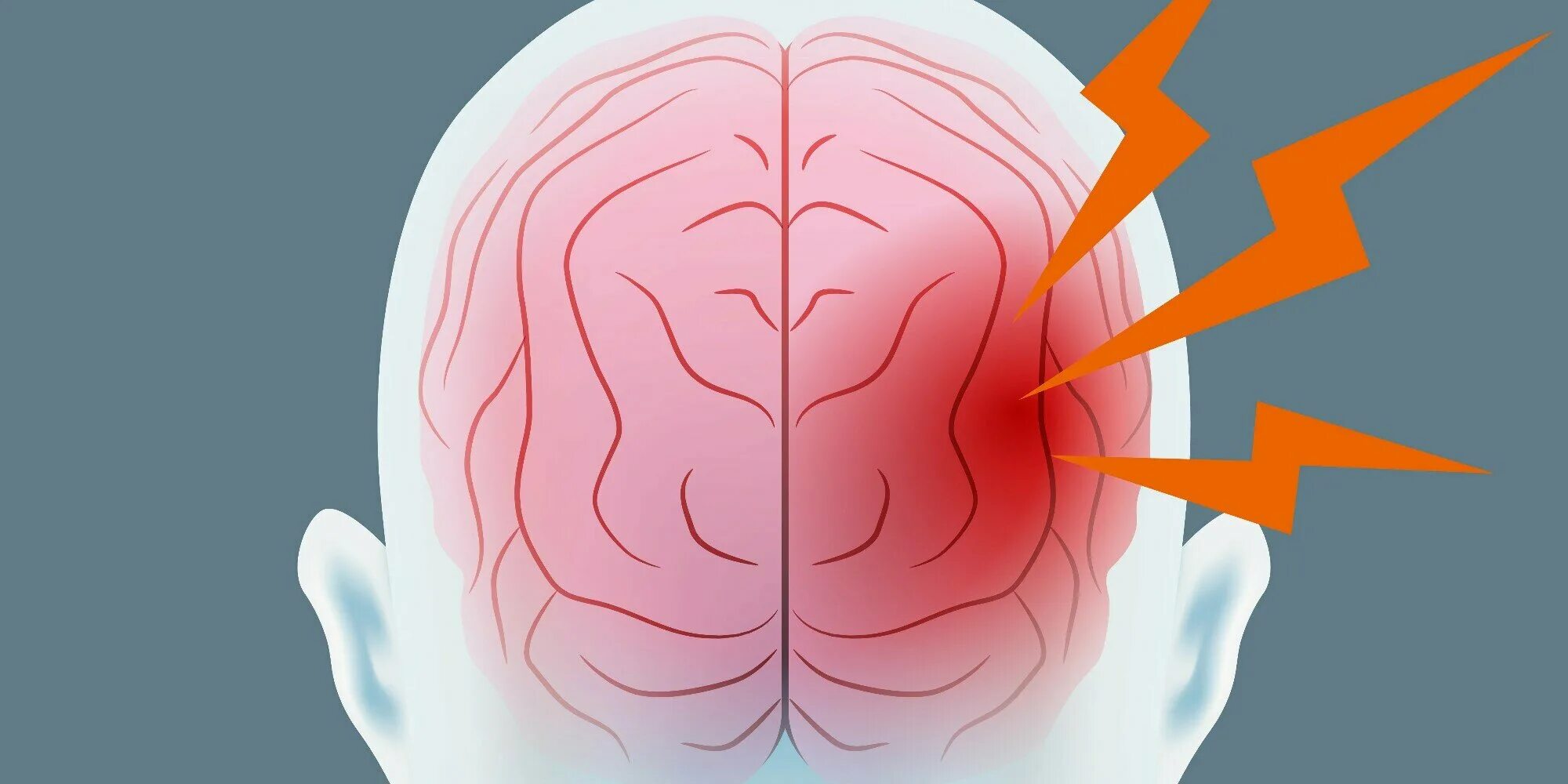 Левое полушарие мозга инсульт. Мигрень цефалгия. Боль напряжения в голове.