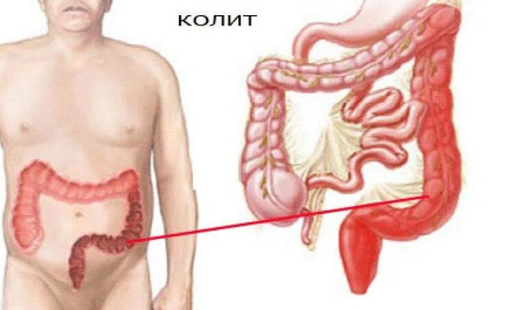 Сильно болят кишки. Язвенный катаральный колит. Заболевания кишечника долихосигма кишечника. Энтероколит язвенный колит. Язвенный колит толстой кишки.