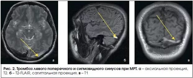 Мрт тромбоз