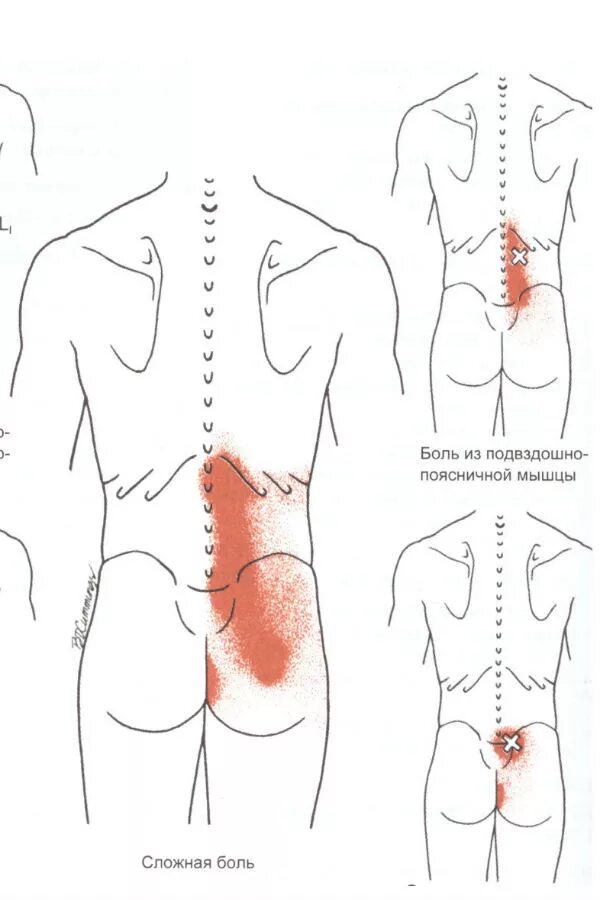 Болит ниже спины справа. Мышцы шеи триггерные точки схема. Триггерные точки поясничного отдела. Боль в пояснице триггерные точки. Квадратная поясничная мышца триггерные точки.