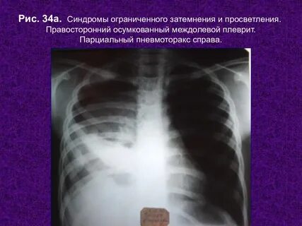 Правосторонний плеврит