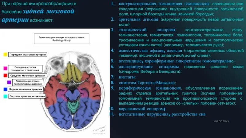 Инсульт правого бассейна. Ишемический инсульт височной доли клиника. Зоны поражения при ишемическом инсульте. Симптомы поражения средней мозговой артерии. Инсульт средней мозговой артерии симптомы.