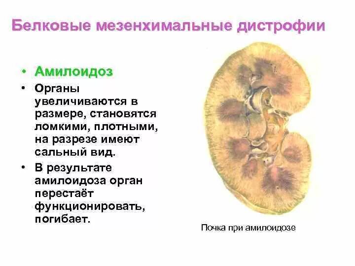 Мезенхимальные белковые. Амилоидоз почек патанатомия. Белковая дистрофия почек. Амилоидоз почек патоморфология.