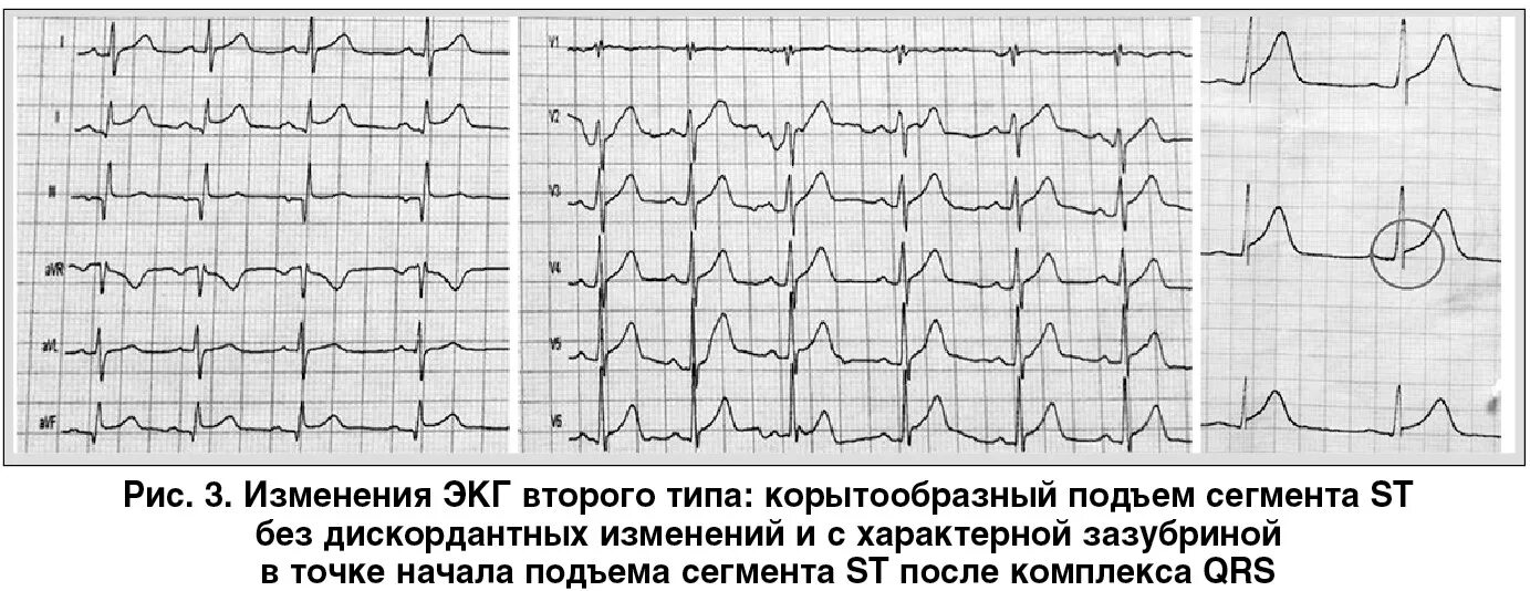 Подъем сегмента st на экг. Окс с подъёмом st экг. сегмент st на экг окс. экг при окс с подъемом сегмента st.