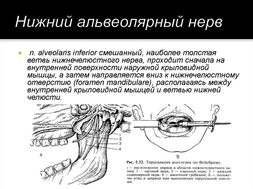 Парестезия анестезии. Мандибулярная анестезия методика. Торусальная анестезия методика. Торусальная анестезия по Вейсбрему. Торусальная анестезия методика проведения.