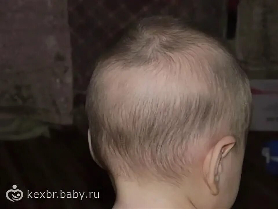 Белая полоса на голове. Полосы на голове у ребенка. Волосы у новорожденных на голове. Белый волос на затылке у грудничка.