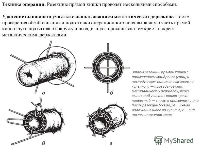 Выпадение кишки операция