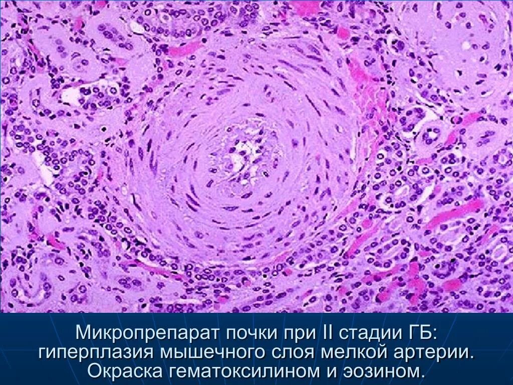 Микропрепарат головного мозга. Почка при злокачественной гипертонии микропрепарат. Почка при гипертонической болезни микропрепарат. Окраска гематоксилином и эозином. Артериальная гипертензия гистология.