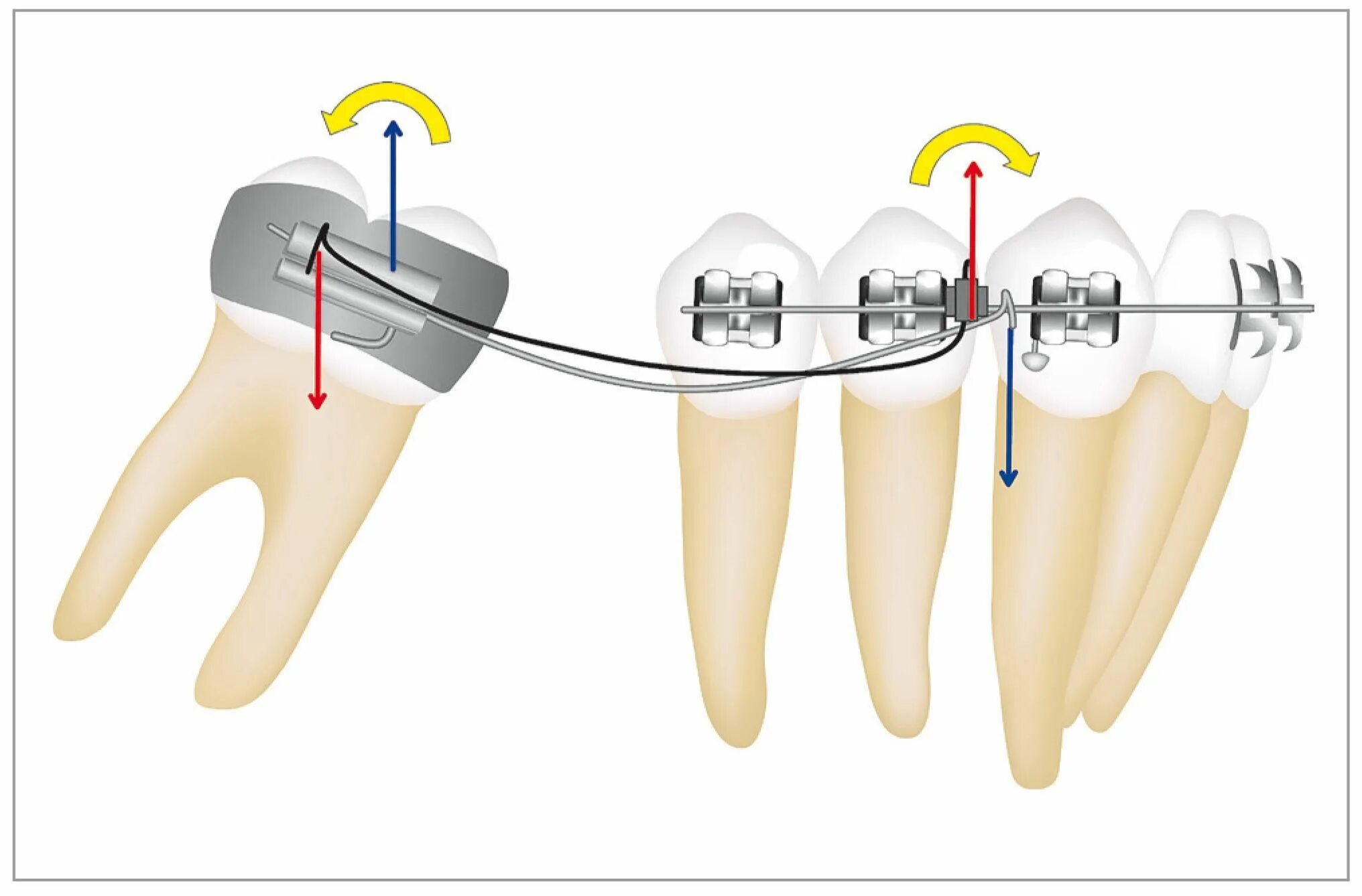 Third molar mesialisation. Two tooths