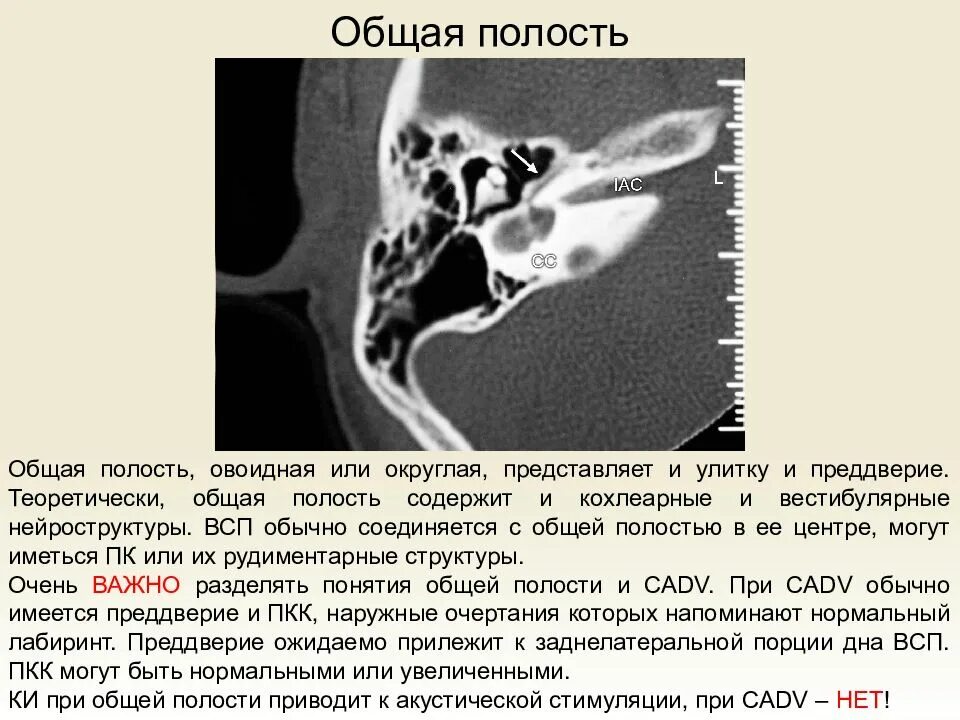 Отит на кт височных костей описание. Кт височных костей при отите. Хронический Гнойный средний отит кт. Отит кт височной кости. Описание гнойного