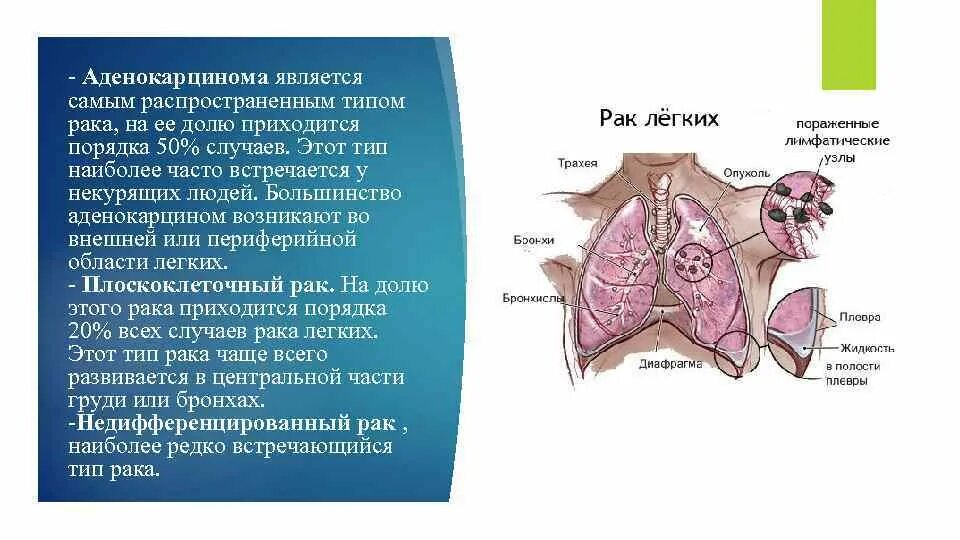 Стадии рака бронха. Аденокарцинома легкого. Аденокарцинома чаще встречается. Аденокарцинома бронха патогенез. Аденокарцинома лёгкого 3а стадия.