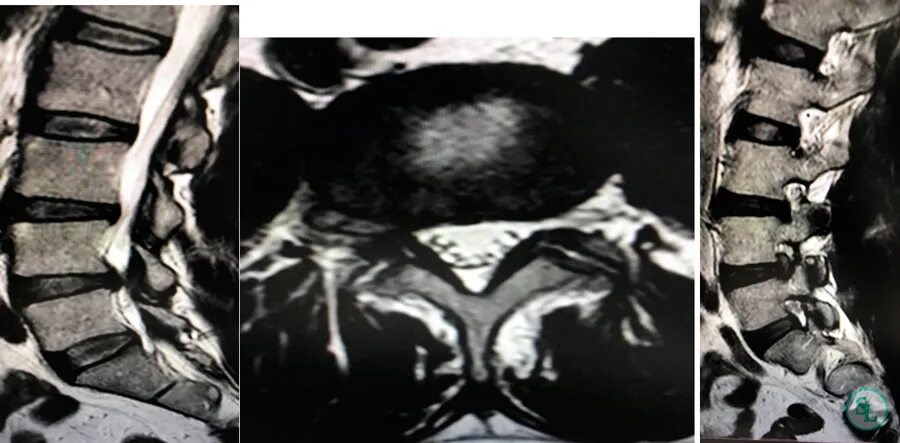 Экструзия дисков шейного отдела позвоночника. Экстрафораминальная грыжа диска l4-l5. Экструзия диска l5-s1 9мм. Фораминальная экструзия диска l4-l5. Дорзальная грыжа l4-l5.