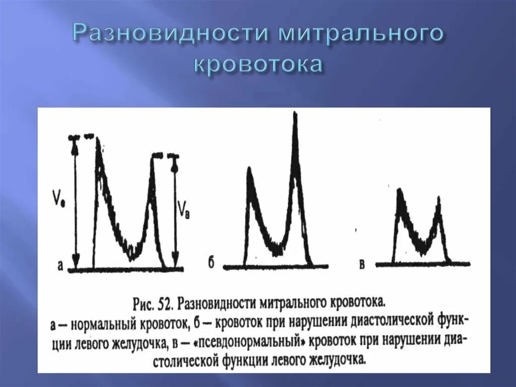 Степени диастолической дисфункции. Диастолическая функция левого желудочка. Диастолическая дисфункция левого желудочка. Диастолическая дисфункция левого желудочка 1 типа что это такое. Диастолическая дисфункция на ЭХОКГ.