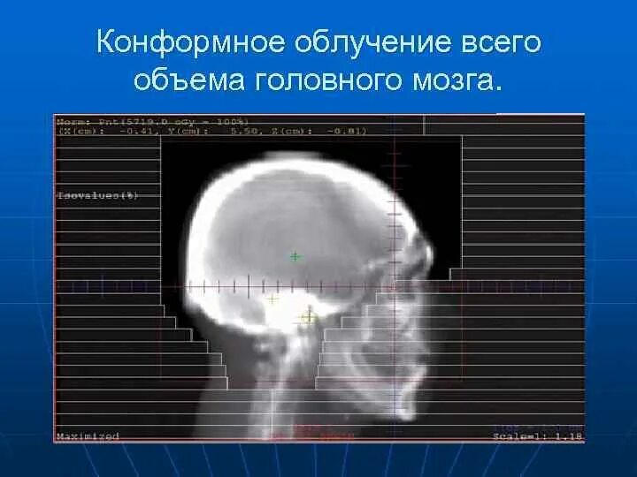 Конформная лучевая. Трехмерная конформная лучевая терапия. Конформная Дистанционная лучевая терапия это. Лучевая терапия головного мозга. Лучевая терапия при опухоли головного мозга.