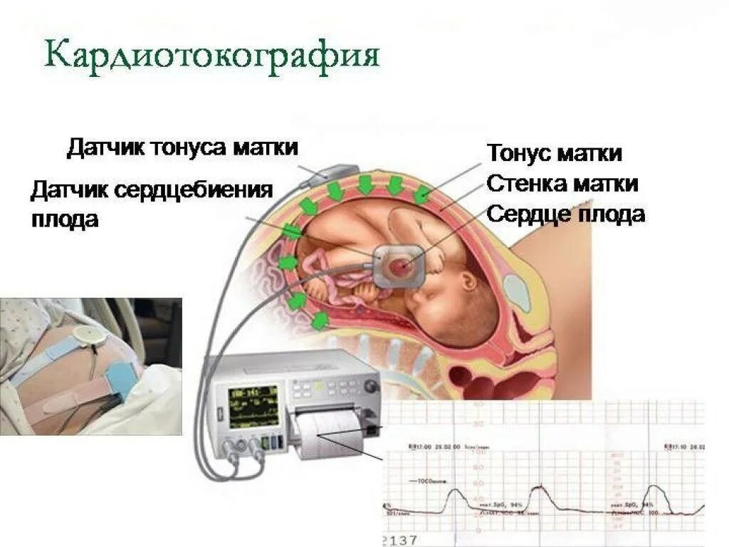 Исследование сердцебиения плода. КТГ при тонусе матки при беременности. Гипертонус матки на УЗИ при беременности. Кардиотокография плода УЗИ.