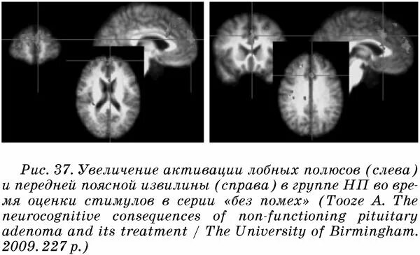 Диэнцефальная дисфункция головного мозга