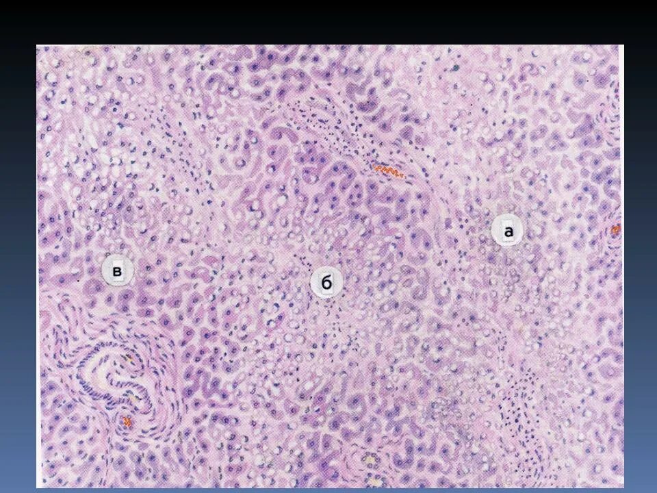 Токсическая дистрофия печени. Некроз гепатоцитов гистология. Острый массивный некроз печени микропрепарат. Острый массивный некроз печени гистология. Некроз печени гепатит микропрепарат.
