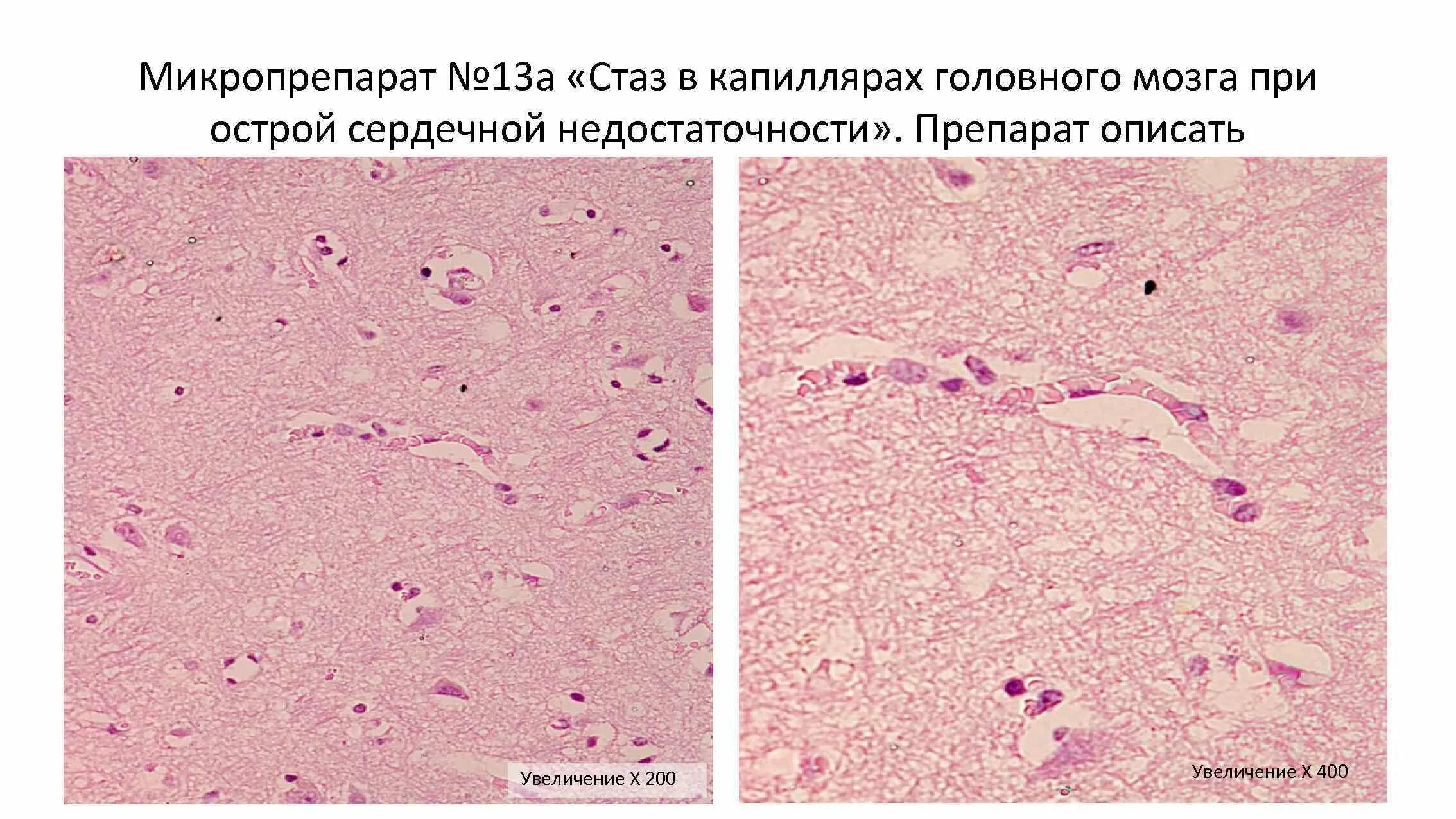 Стаз в сосудах головного мозга микропрепарат. Стаз в капиллярах головного мозга микропрепарат. Венозное полнокровие микропрепарат. Тромб микропрепарат