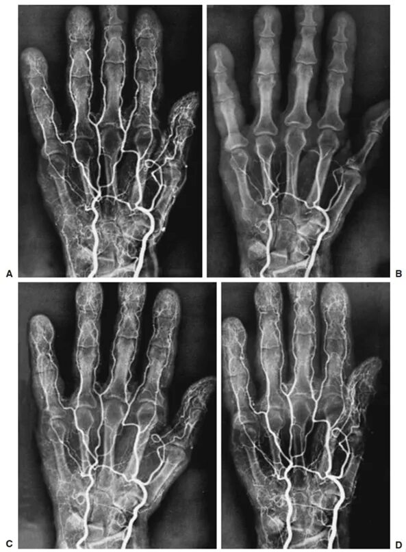 Синдром Рейно ангиография. Синдром Рейно холодовая проба. Повреждение мелких артерий кистей и стоп