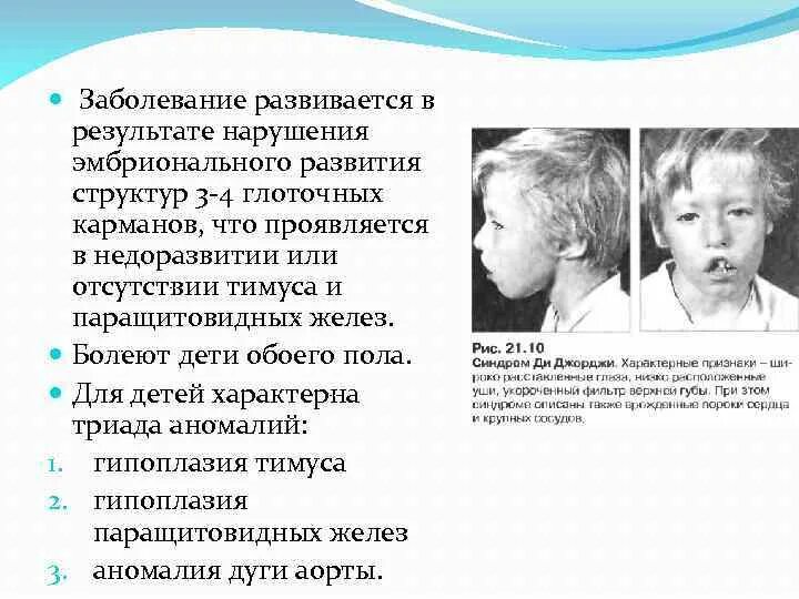 Гипоплазия тимуса у детей. Развития 3-4 глоточных карманов. Нарушение эмбриональной закладки тимуса. Врожденное отсутствие тимуса характерно для синдрома.