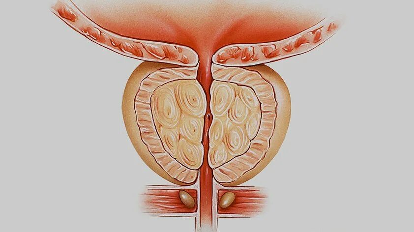 Воспалился простатит. Воспаление семенных пузырьков. Семенные пузырики воспаление.