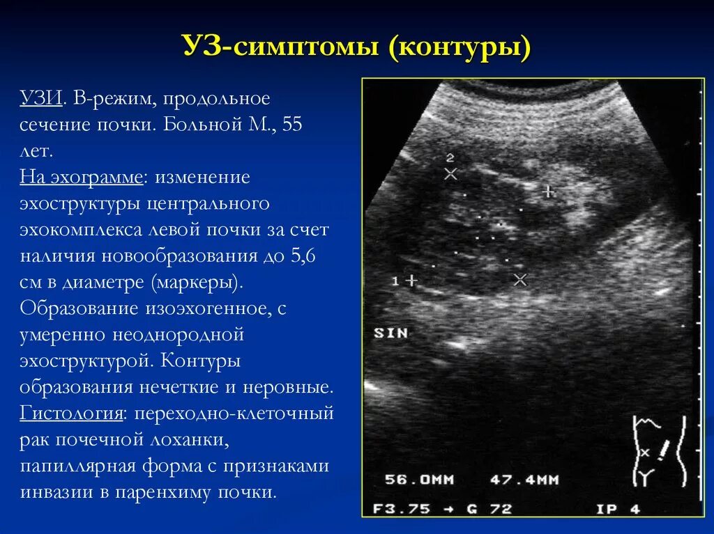 Узи почек диагнозы. УЗИ почек. Исследование почек УЗИ. Почка при УЗИ. Ультразвуковая диагностика пиелонефрита.