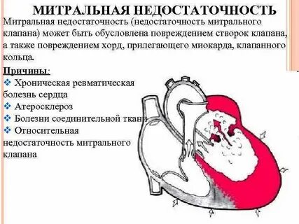Врожденная митральная недостаточность вмн по утвержденным