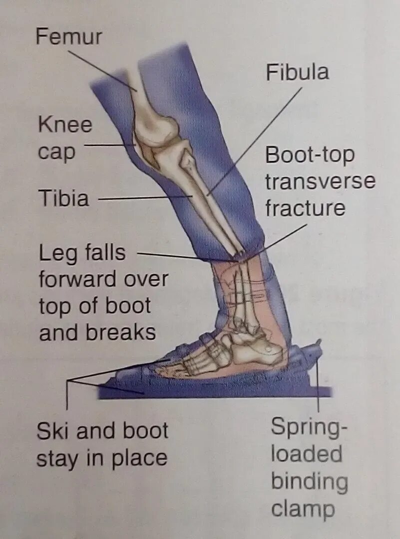 Через сколько срастается кость. Как срастается кость в ноге. Сколько срастаются кости. Сращение берцовых костей ноги.